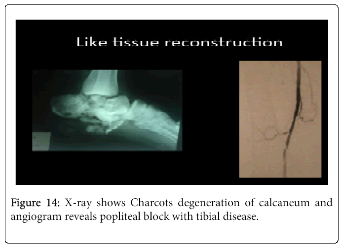 Foot-Ankle-X-ray-shows-Charcots-degeneration-calcaneum