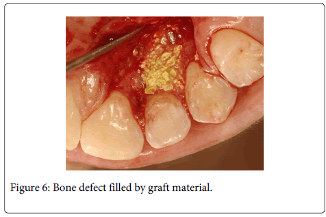 Interdisciplinary-Medicine-Dental-Bone-graft-material