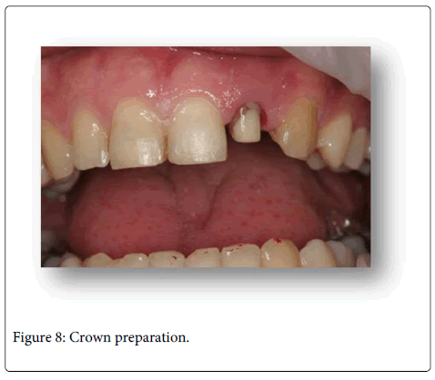 Interdisciplinary-Medicine-Dental-Crown-preparation