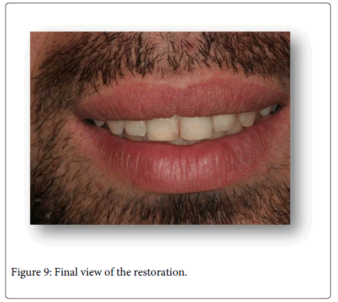 Interdisciplinary-Medicine-Dental-Crown-preparation