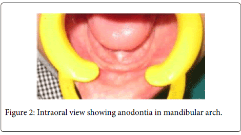 Interdisciplinary-Medicine-Dental-Intraoral-anodontia-mandibular