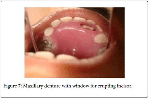 Interdisciplinary-Medicine-Dental-Maxillary-erupting-incisor