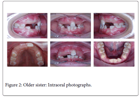 Interdisciplinary-Medicine-Dental-Older-sister-Intraoral-photographs