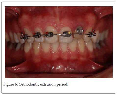 Interdisciplinary-Medicine-Dental-Orthodontic-extrusion-period