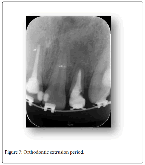 Interdisciplinary-Medicine-Dental-Orthodontic-extrusion-period
