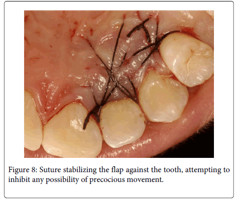 Interdisciplinary-Medicine-Dental-Suture-stabilizing-flap