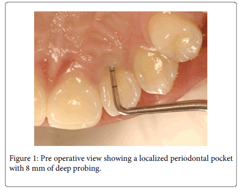 Interdisciplinary-Medicine-Dental-localized-periodontal-pocket