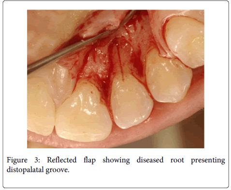 Interdisciplinary-Medicine-Dental-presenting-distopalatal-groove