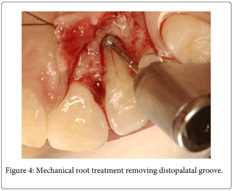 Interdisciplinary-Medicine-Dental-removing-distopalatal-groove