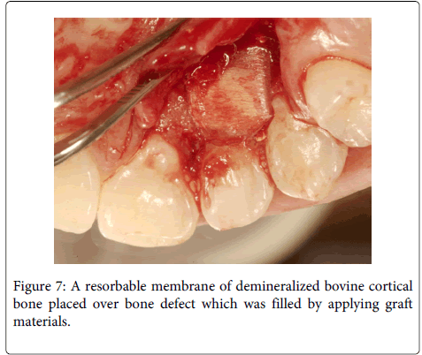 Interdisciplinary-Medicine-Dental-resorbable-membrane-demineralized