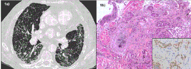 Subpleural