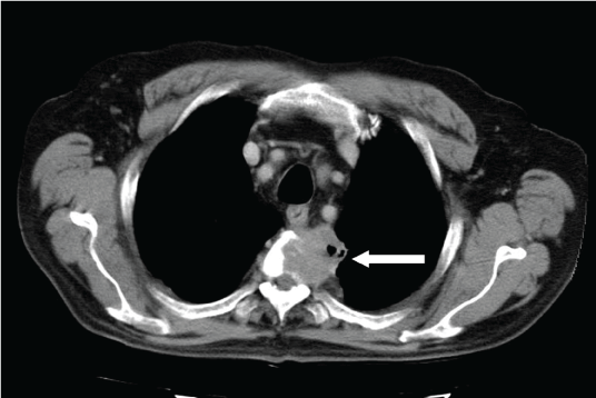 mediastinal