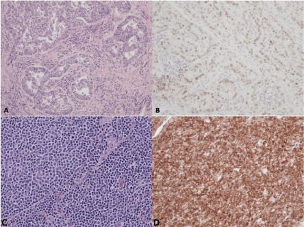 neoplastic