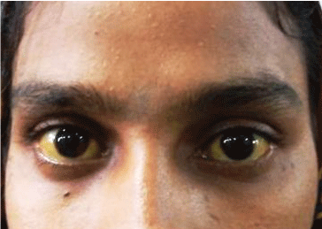 sclera