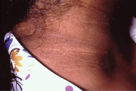 Acanthosis
