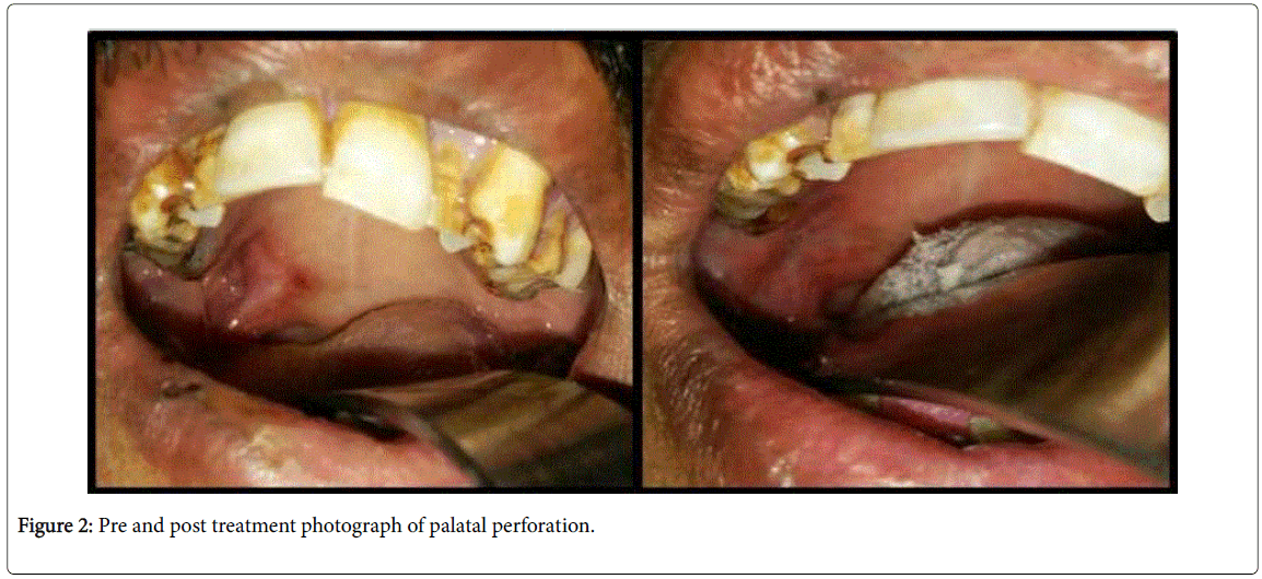 Submandibular Abscess with Velopharyngeal Insufficiency Unusual