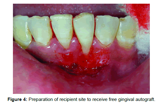 Medicine-Dental-Preparation-of-recipient