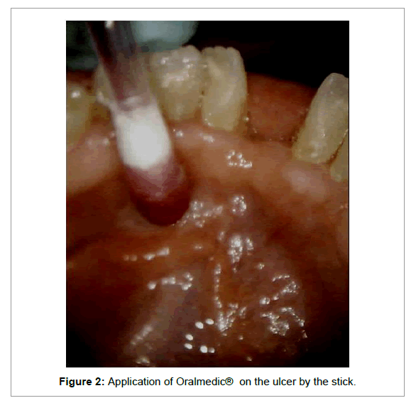 Medicine-Dental-Science-Application-Oralmedic-ulcer
