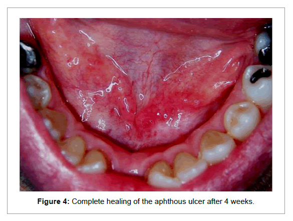 Medicine-Dental-Science-Complete-healing-aphthous-ulcer