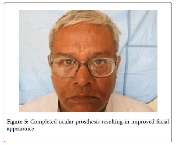 Medicine-Dental-Science-Completed-ocular-prosthesis-resulting