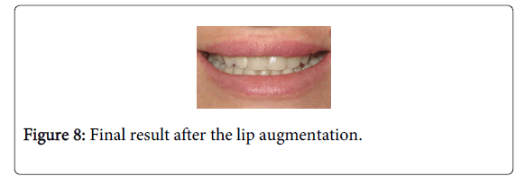 Medicine-Dental-Science-Final-result-after-lip-augmentation
