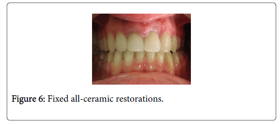 Medicine-Dental-Science-Fixed-all-ceramic-restorations