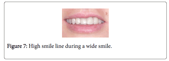 Medicine-Dental-Science-High-smile-line-during-wide-smile