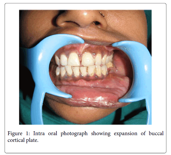 Medicine-Dental-Science-Intra-oral-photograph-showing-expansion