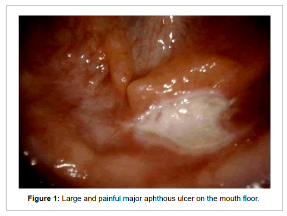 Medicine-Dental-Science-Large-painful-major-aphthous-ulcer