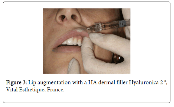Medicine-Dental-Science-Lip-augmentation-HA-dermal-filler