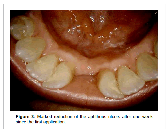 Medicine-Dental-Science-Marked-reduction-aphthous-ulcers