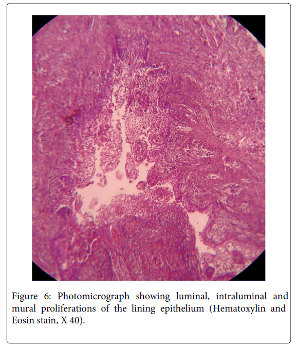 Medicine-Dental-Science-Photomicrograph-showing-luminal-intraluminal