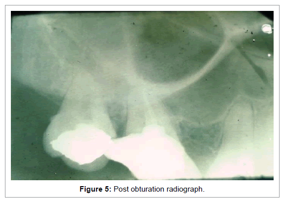 Medicine-Dental-Science-Post-obturation-radiograph