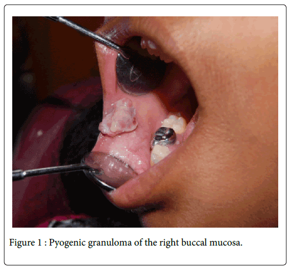 Medicine-Dental-Science-Pyogenic-granuloma-right-buccal-mucosa