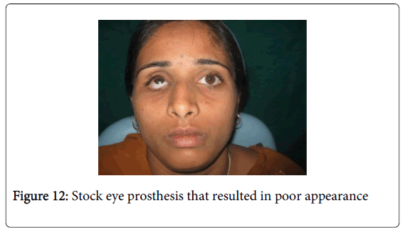 Medicine-Dental-Science-Stock-eye-prosthesis-that-resulted