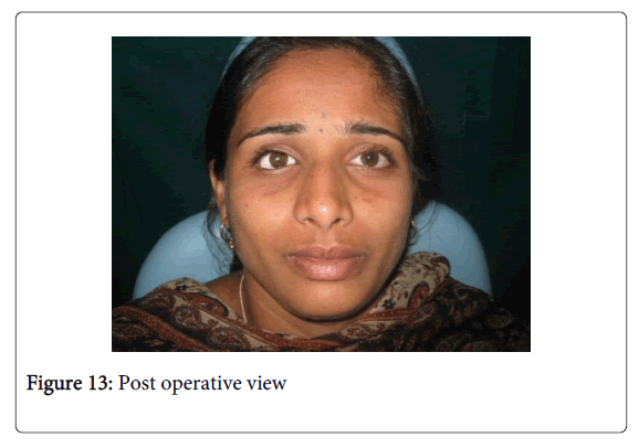 Medicine-Dental-Science-Stock-eye-prosthesis-that-resulted