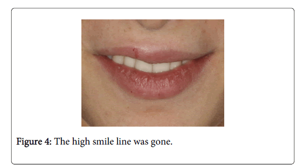 Medicine-Dental-Science-The-high-smile-line-was-gone