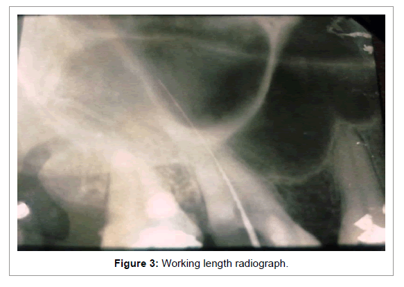 Medicine-Dental-Science-Working-length-radiograph