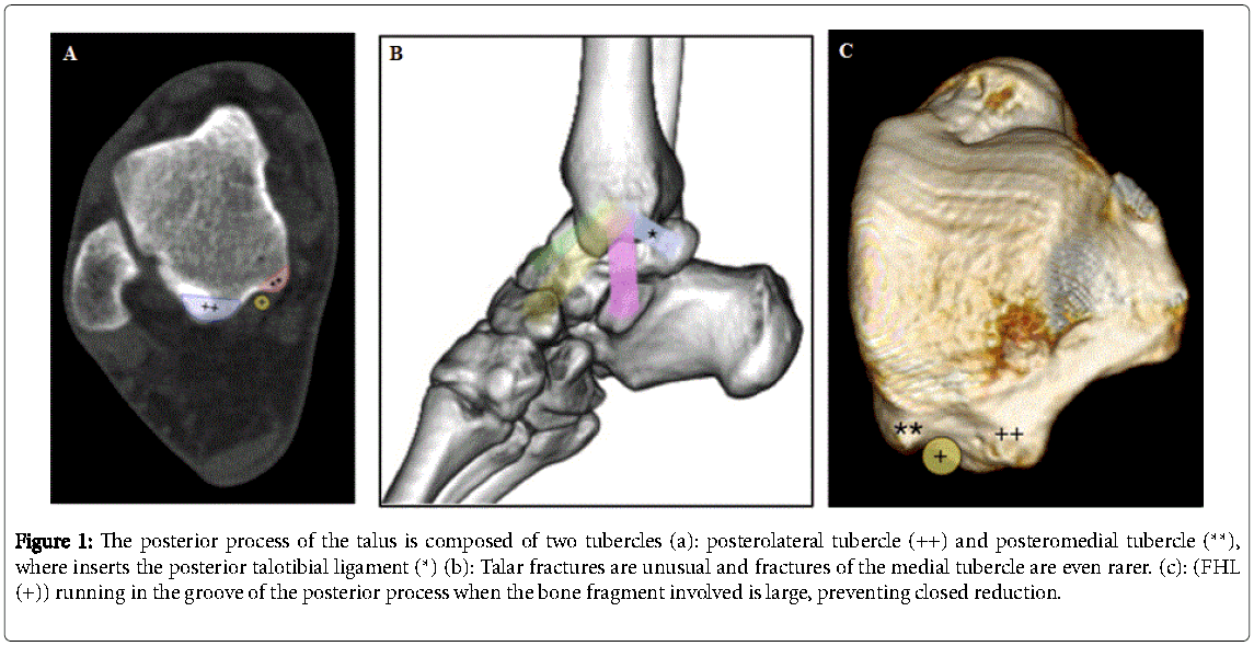 talus fracture treatment talus fracture treatment