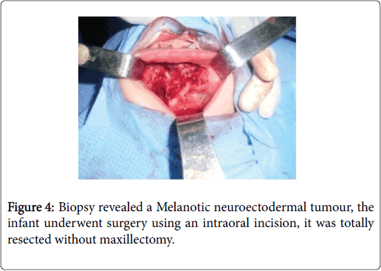 Otolaryngology-Biopsy-revealed