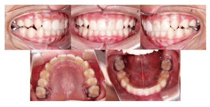 Intraoral