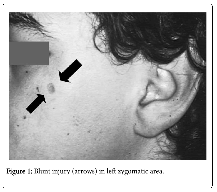 Palliative-Care-Blunt-injury-arrows-left-zygomatic-area