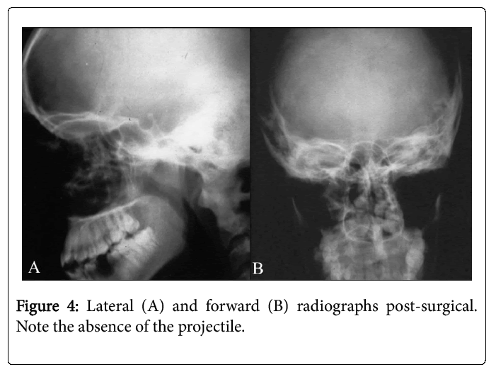 Palliative-Care-Lateral-forward-radiographs-post-surgical