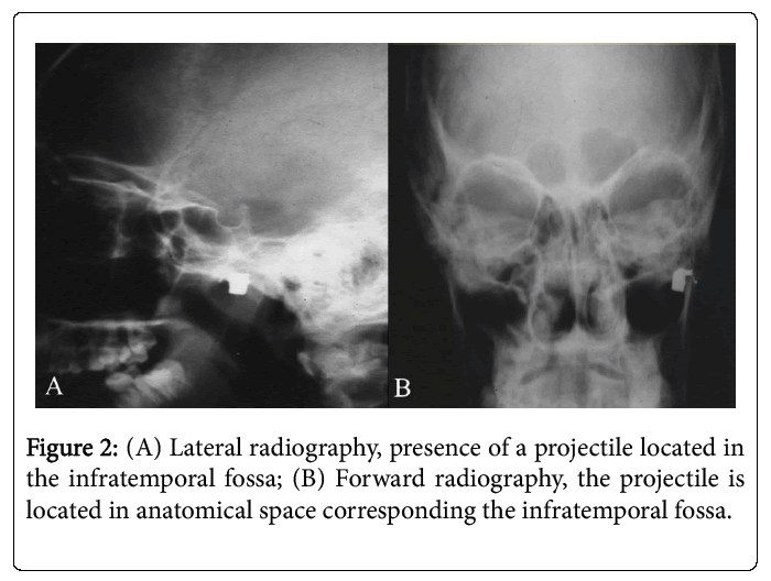 Palliative-Care-Lateral-radiography-presence-projectile-located