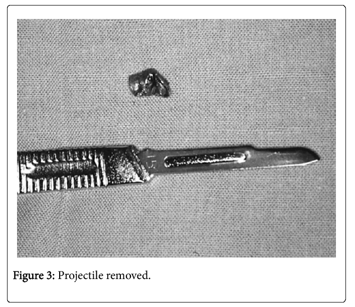 Palliative-Care-Projectile-removed
