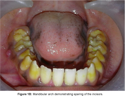 Pediatric-Dental-Care-Mandibular-arch