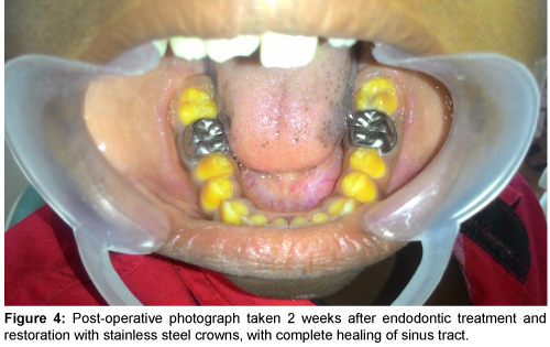 Pediatric-Dental-Care-Post-operative