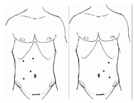 laparoscopic
