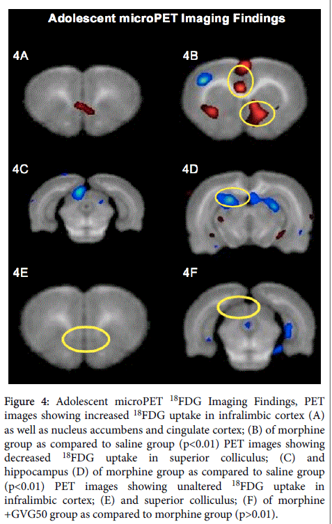 addiction-research-therapy-Adolescent-microPET