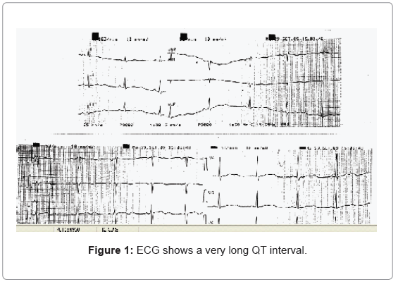 addiction-research-experimental-ECG-shows